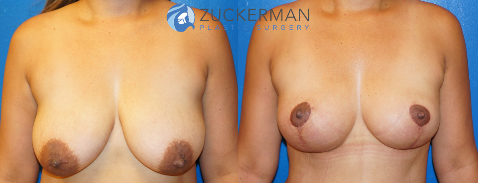 breast lift, joshua zuckerman, featured, 2, frontal view