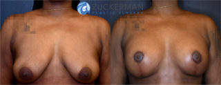 breast lift, joshua zuckerman, featured, 3, frontal view, combined breast augmentation