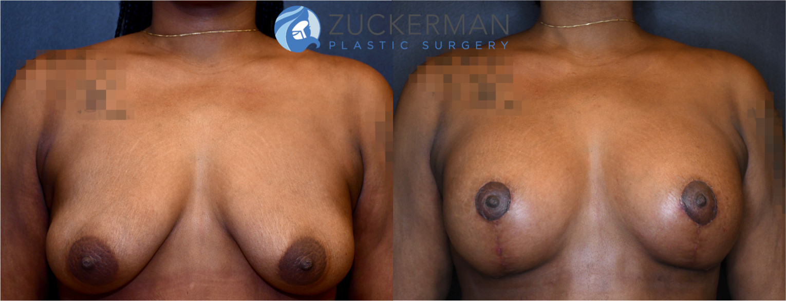 breast lift, joshua zuckerman, featured, 3, frontal view, combined breast augmentation