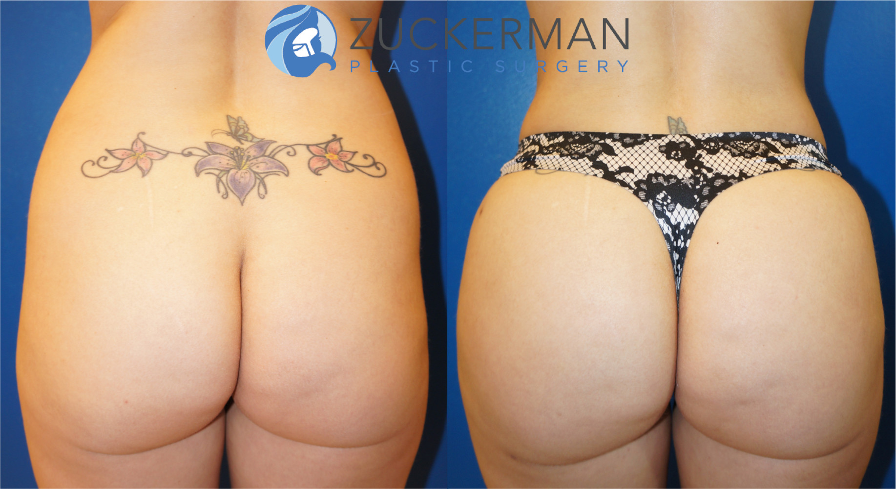 brazilian butt lift, bbl, buttock augmentation, joshua zuckerman, featured, 3, fat grafting, buttocks, posterior view