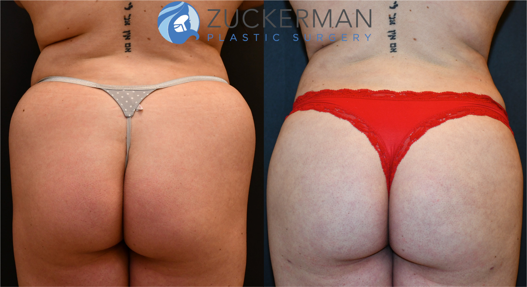 brazilian butt lift, bbl, buttock augmentation, joshua zuckerman, featured, 2, fat grafting, buttocks, posterior view