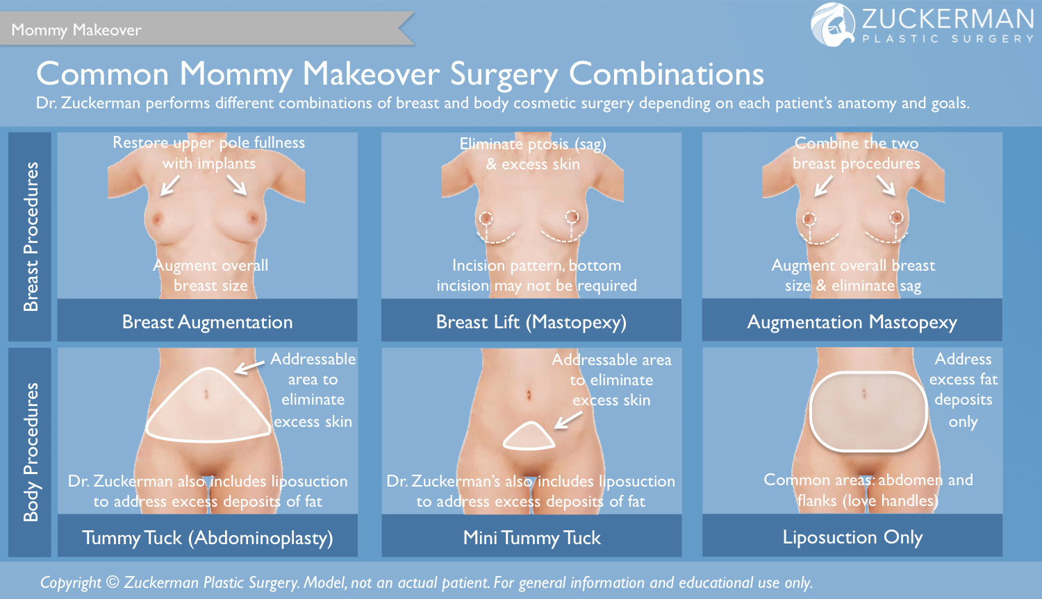 mommy makeover, combinations, mother, pre-pregnancy figure, plastic surgery