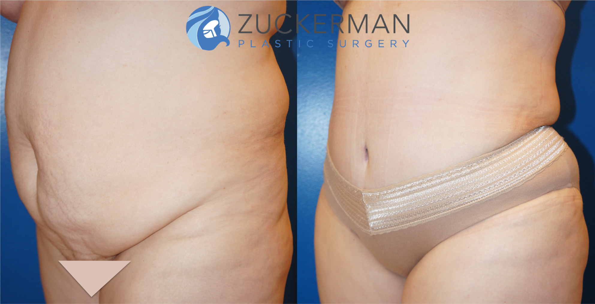 tummy tuck, abdominoplasty, joshua zuckerman, 21, left oblique