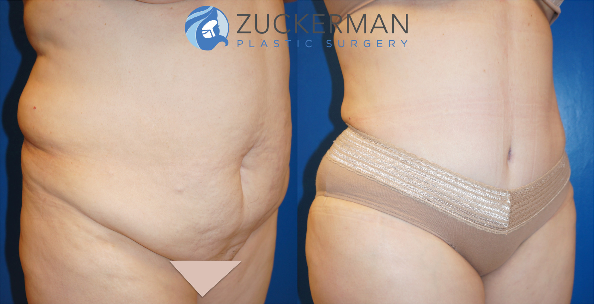 tummy tuck, abdominoplasty, joshua zuckerman, 21, right oblique