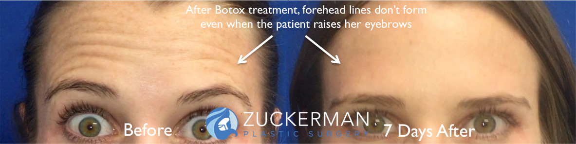 botox, cosmetic, before and after, featured, 1, forehead lines, zuckerman plastic surgery, new york city, nyc, manhattan