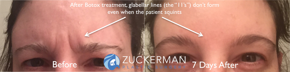botox, cosmetic, before and after, featured, 2, glabellar lines, eyebrows, 11's lines, zuckerman plastic surgery, new york city, nyc, manhattan