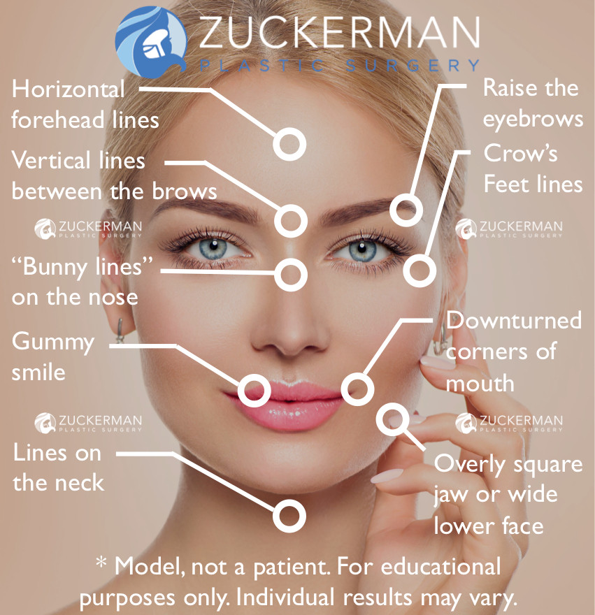botox, possible treatments, forehead lines and wrinkles, vertical lines between eyebrows, glabella, bunny lines, crow's feet, botox brow lift, gummy small, wide face, square jaw, neck lines