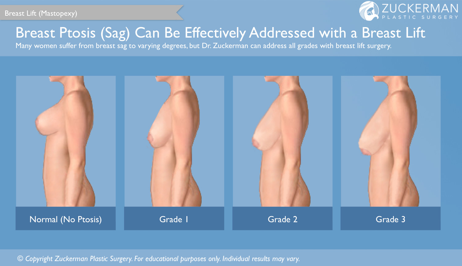 breast lift, breast sag, ptosis, grade 1, grade 2, grade 3