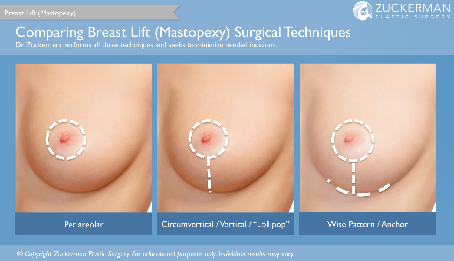 breast lift, incisions, techniques, periareolar, circumvertical, lollilop, vertical, wise pattern, anchor