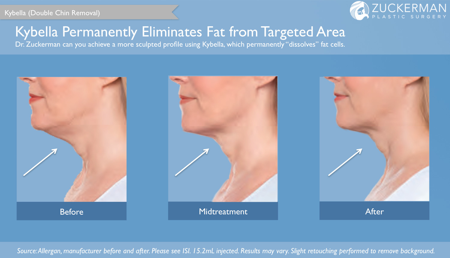 kybella, double chin removal, before and after