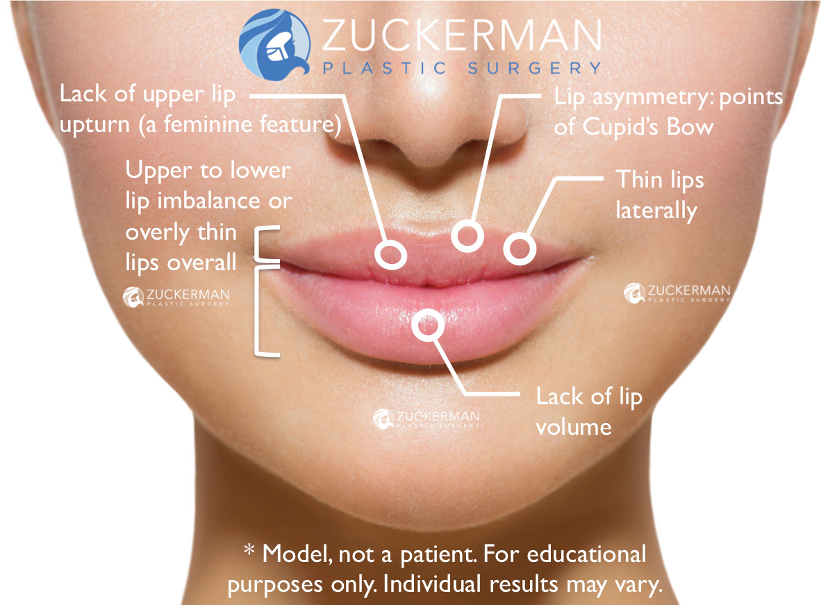 lip augmentation, lip fillers, thin lips, lip asymmetry, cupid's bow, lack of lip volume, thin upper lip