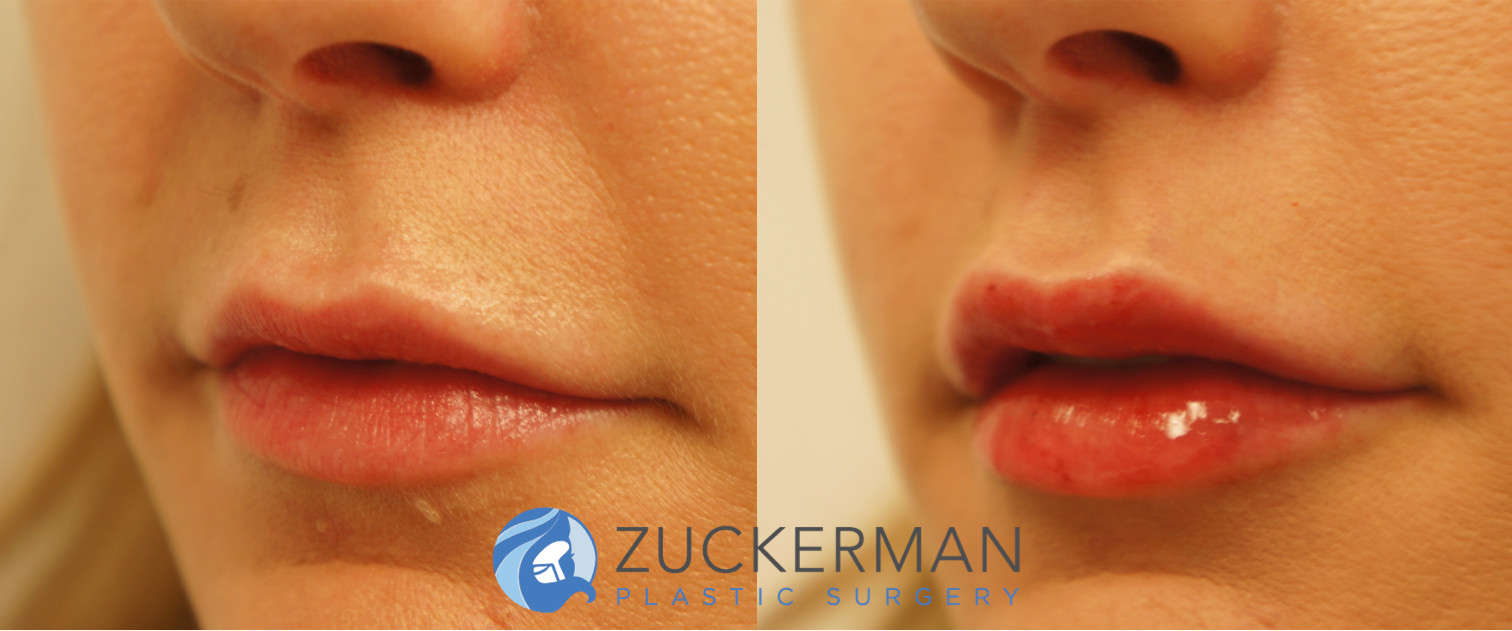 lip augmentation, fillers, before and after, featured 1, left oblique