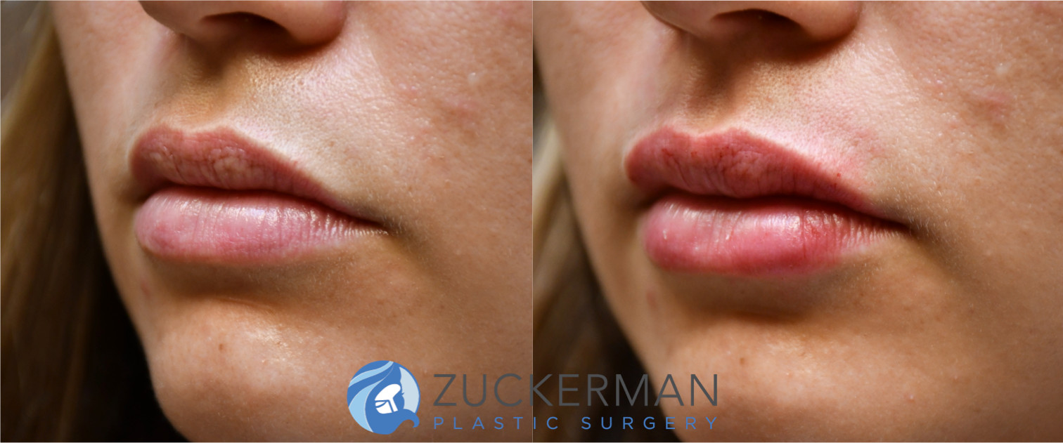 lip augmentation, volbella filler, before and after, subtle, featured, 3, thin lips