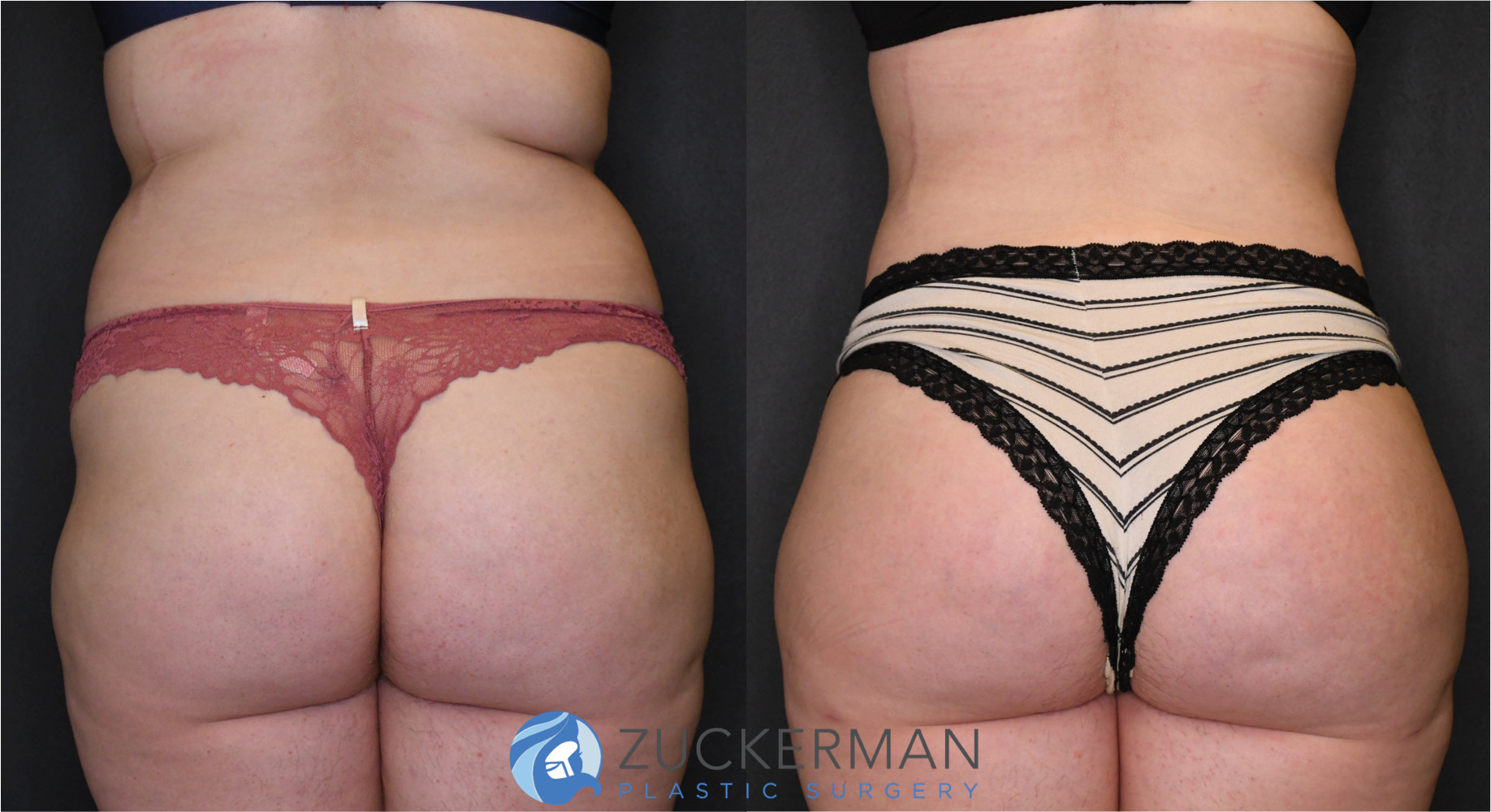 brazilian butt lift, buttock augmentation, bbl, before and after, joshua zuckerman, 10, posterior view