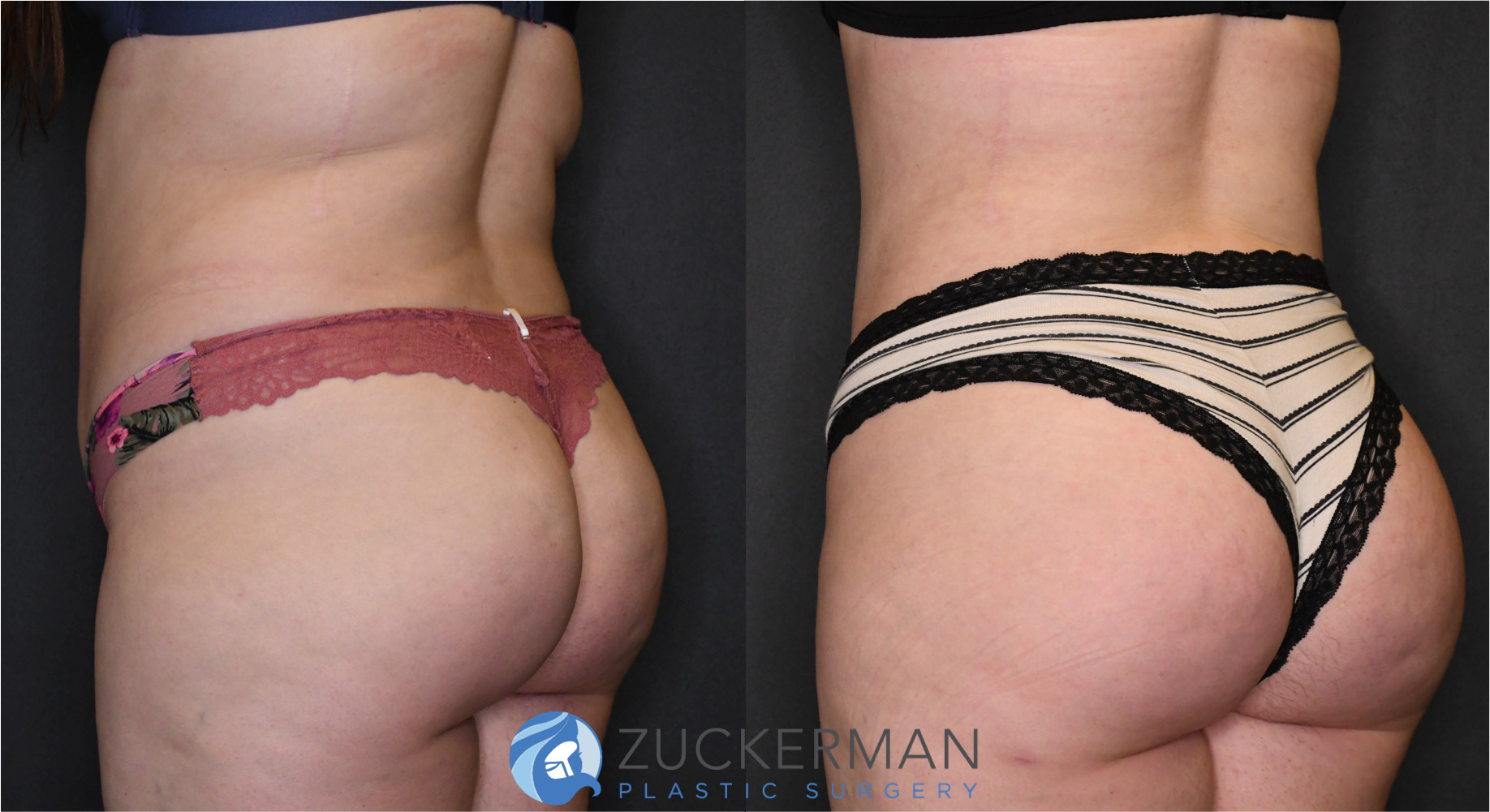 brazilian butt lift, buttock augmentation, bbl, before and after, joshua zuckerman, 10, posterior left oblique view