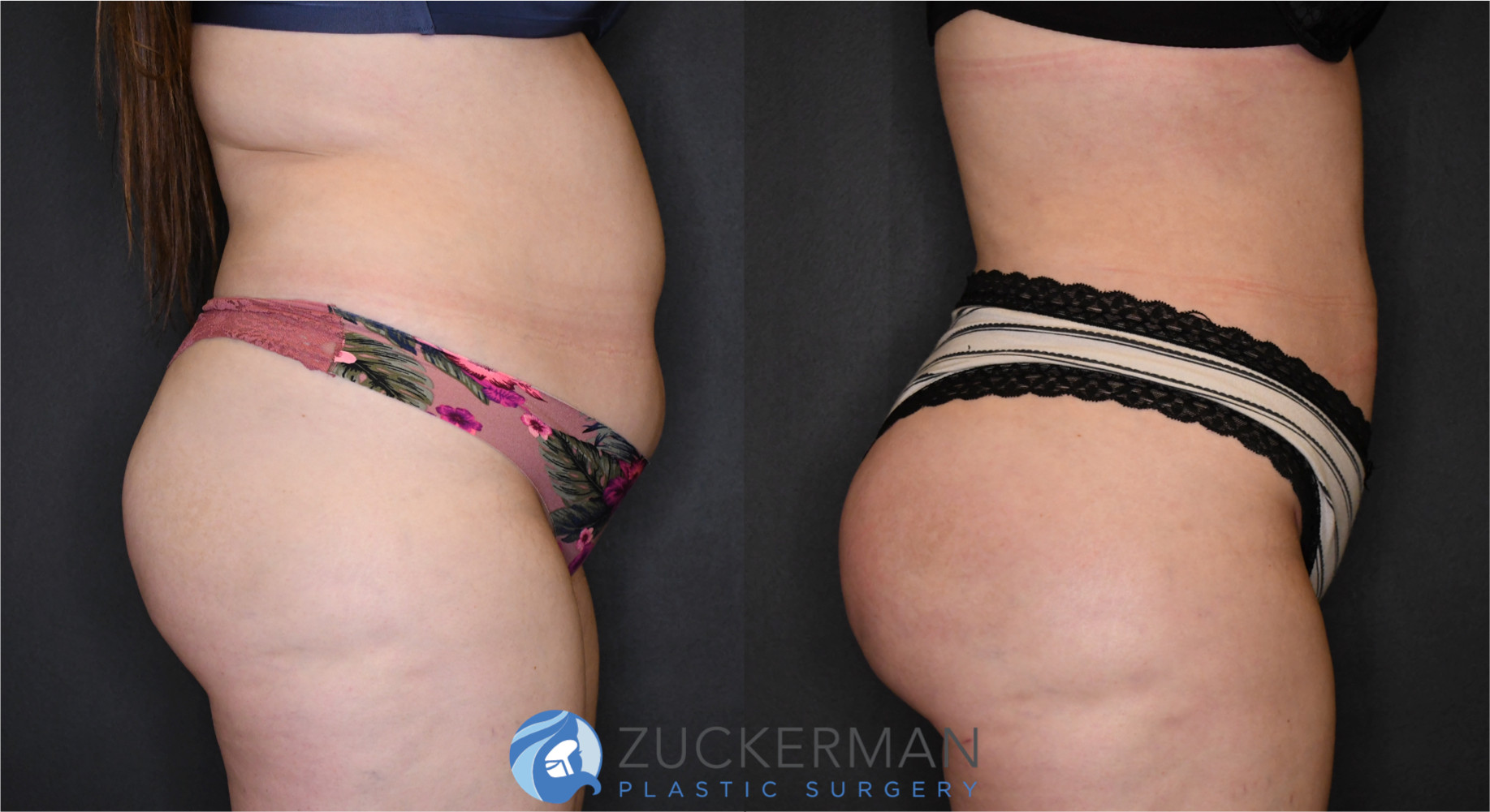 brazilian butt lift, buttock augmentation, bbl, before and after, joshua zuckerman, 10, right profile view
