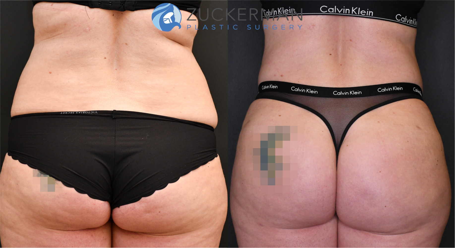 brazilian butt lift, buttock augmentation, bbl, before and after, joshua zuckerman, 11, posterior view