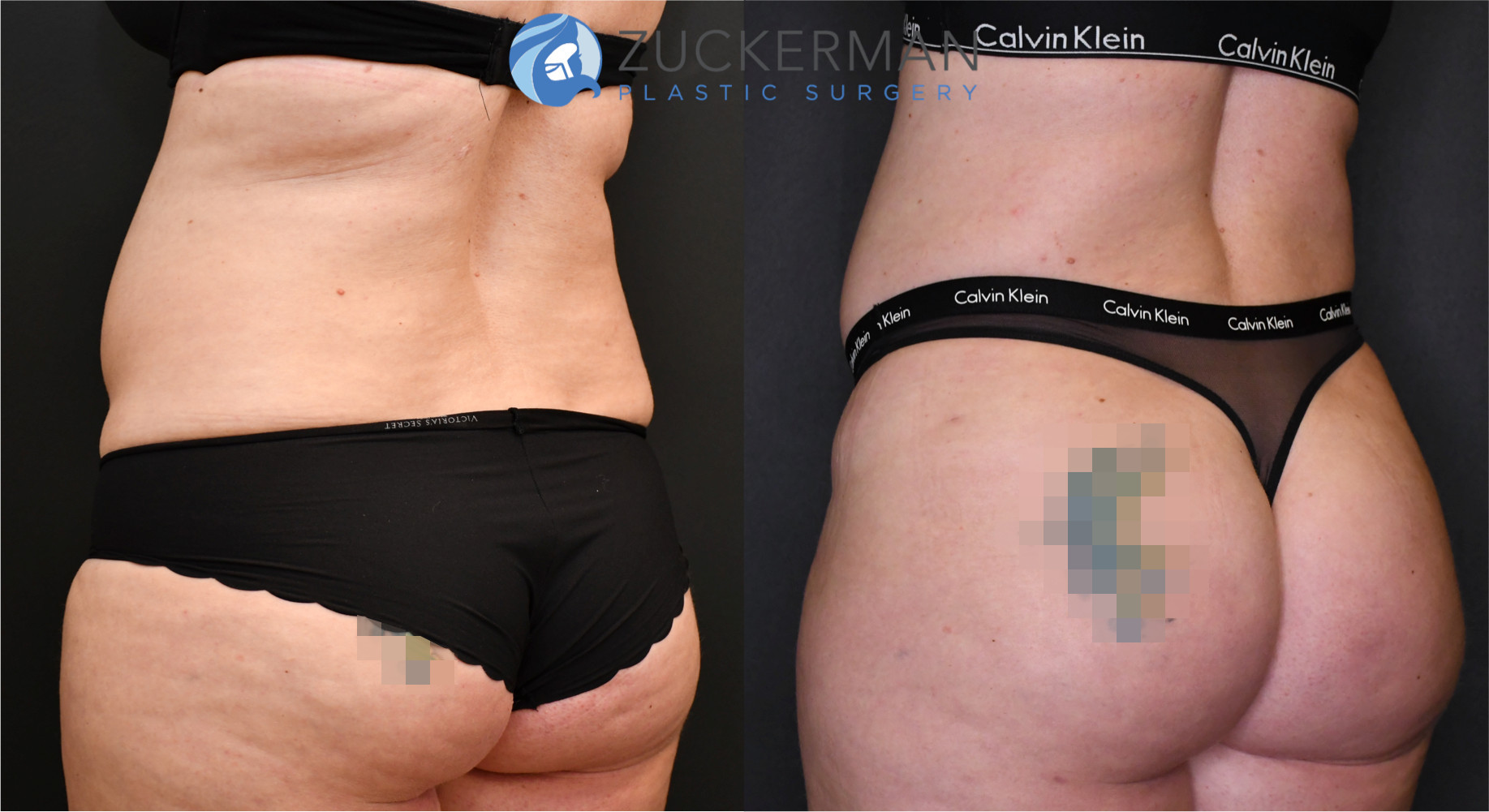 brazilian butt lift, buttock augmentation, bbl, before and after, joshua zuckerman, 11, posterior left oblique view