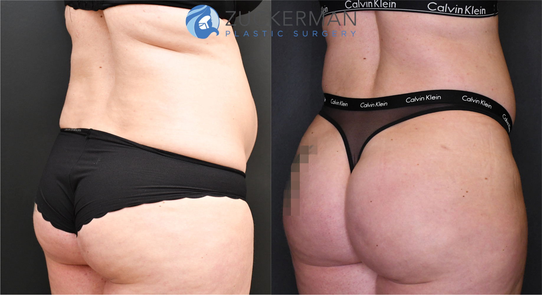 brazilian butt lift, buttock augmentation, bbl, before and after, joshua zuckerman, 11, posterior right oblique view