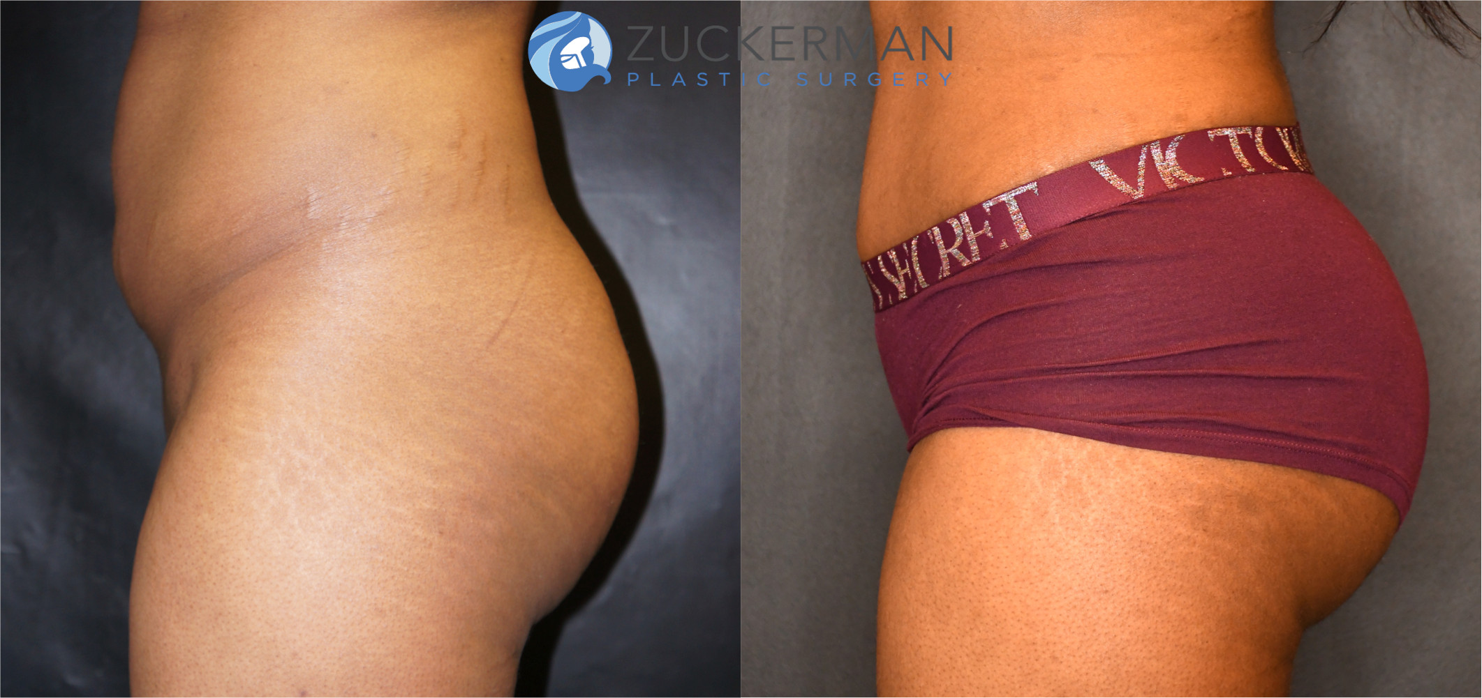 brazilian butt lift, buttock augmentation, bbl, before and after, joshua zuckerman, 12, posterior left profile view