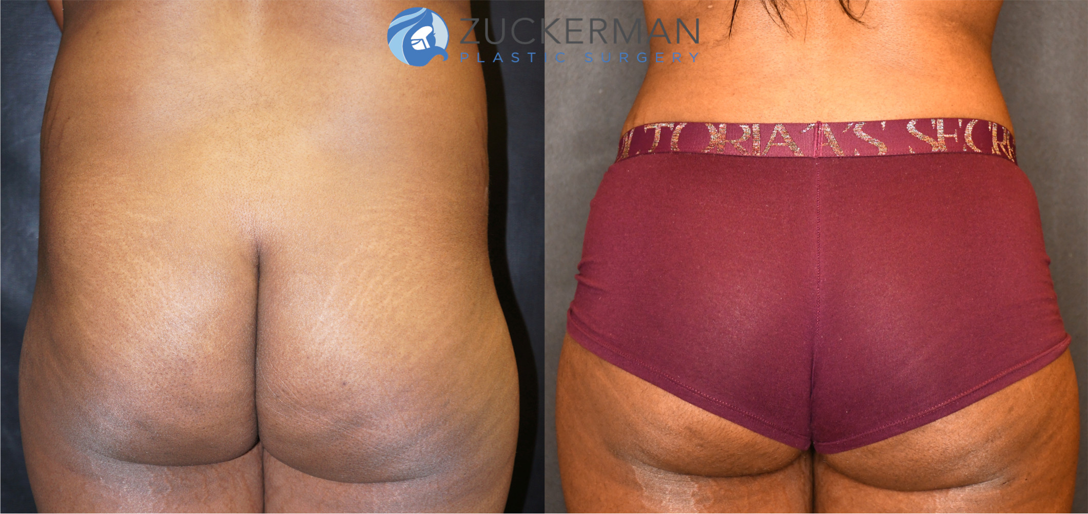 brazilian butt lift, buttock augmentation, bbl, before and after, joshua zuckerman, 12, posterior view