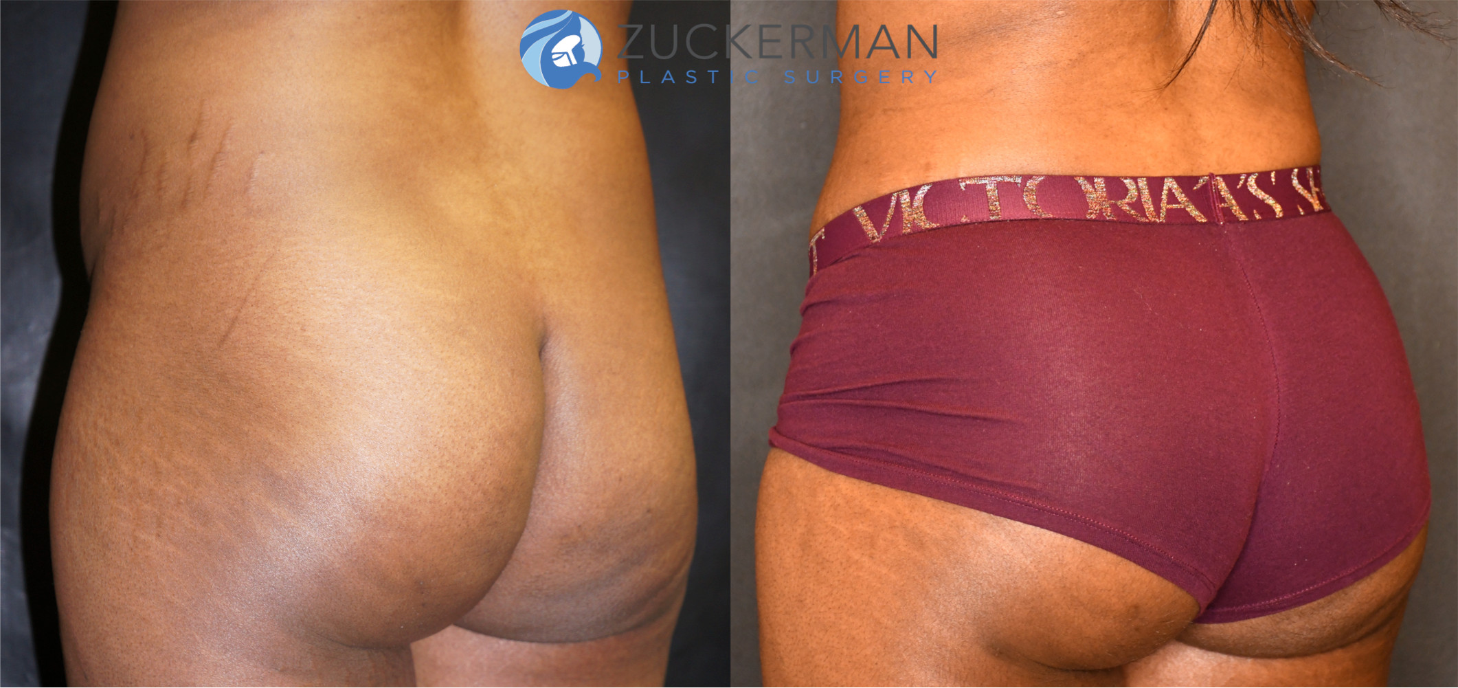 brazilian butt lift, buttock augmentation, bbl, before and after, joshua zuckerman, 12, posterior left oblique view