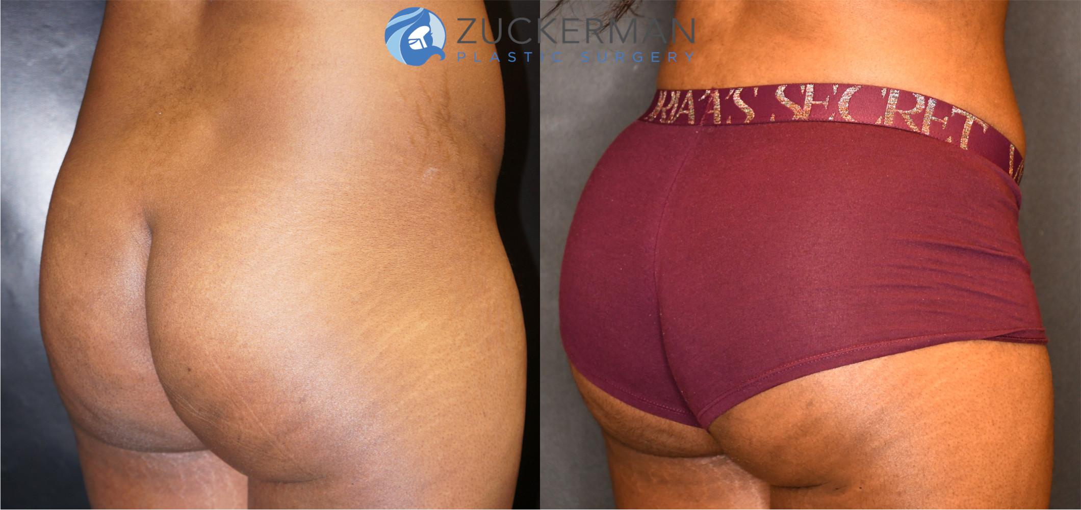 brazilian butt lift, buttock augmentation, bbl, before and after, joshua zuckerman, 12, posterior right oblique view