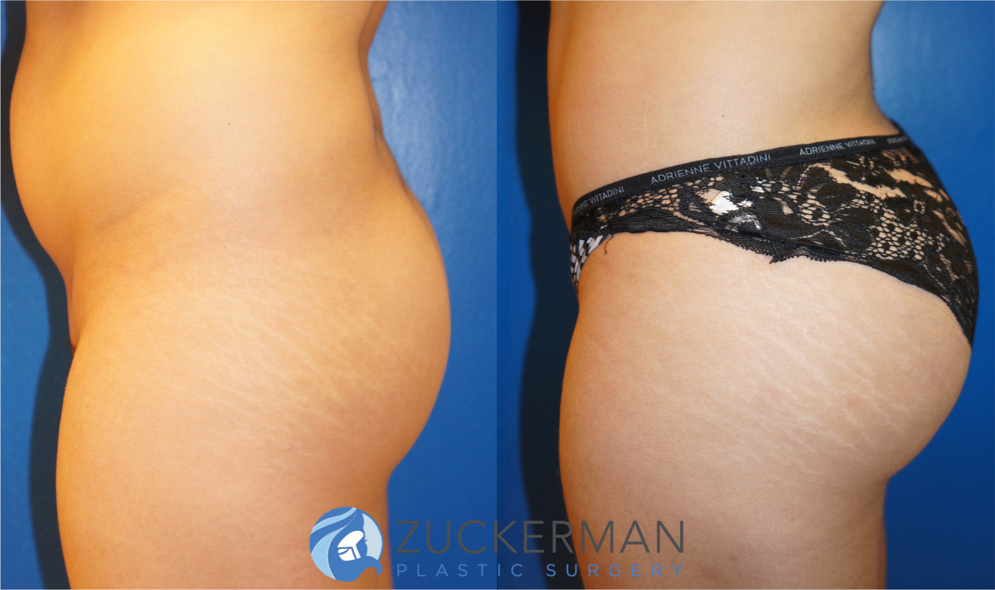 brazilian butt lift, buttock augmentation, bbl, before and after, joshua zuckerman, 3, left profile view