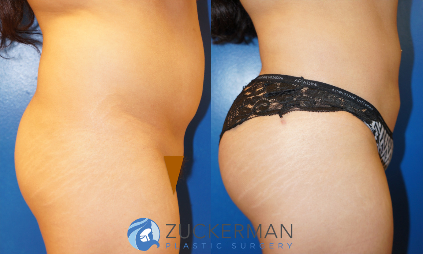 brazilian butt lift, buttock augmentation, bbl, before and after, joshua zuckerman, 3, posterior right profile view
