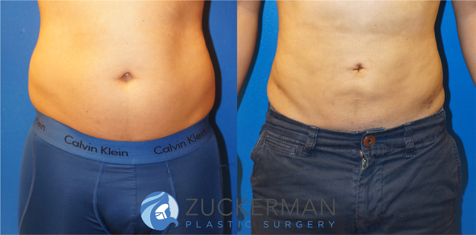 liposuction, abdomen, flanks, lower back, frontal, male, 10, joshua zuckerman md, nyc