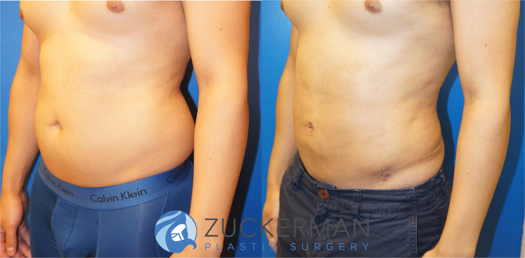 liposuction, abdomen, flanks, lower back, left oblique, male, 10, joshua zuckerman md, nyc