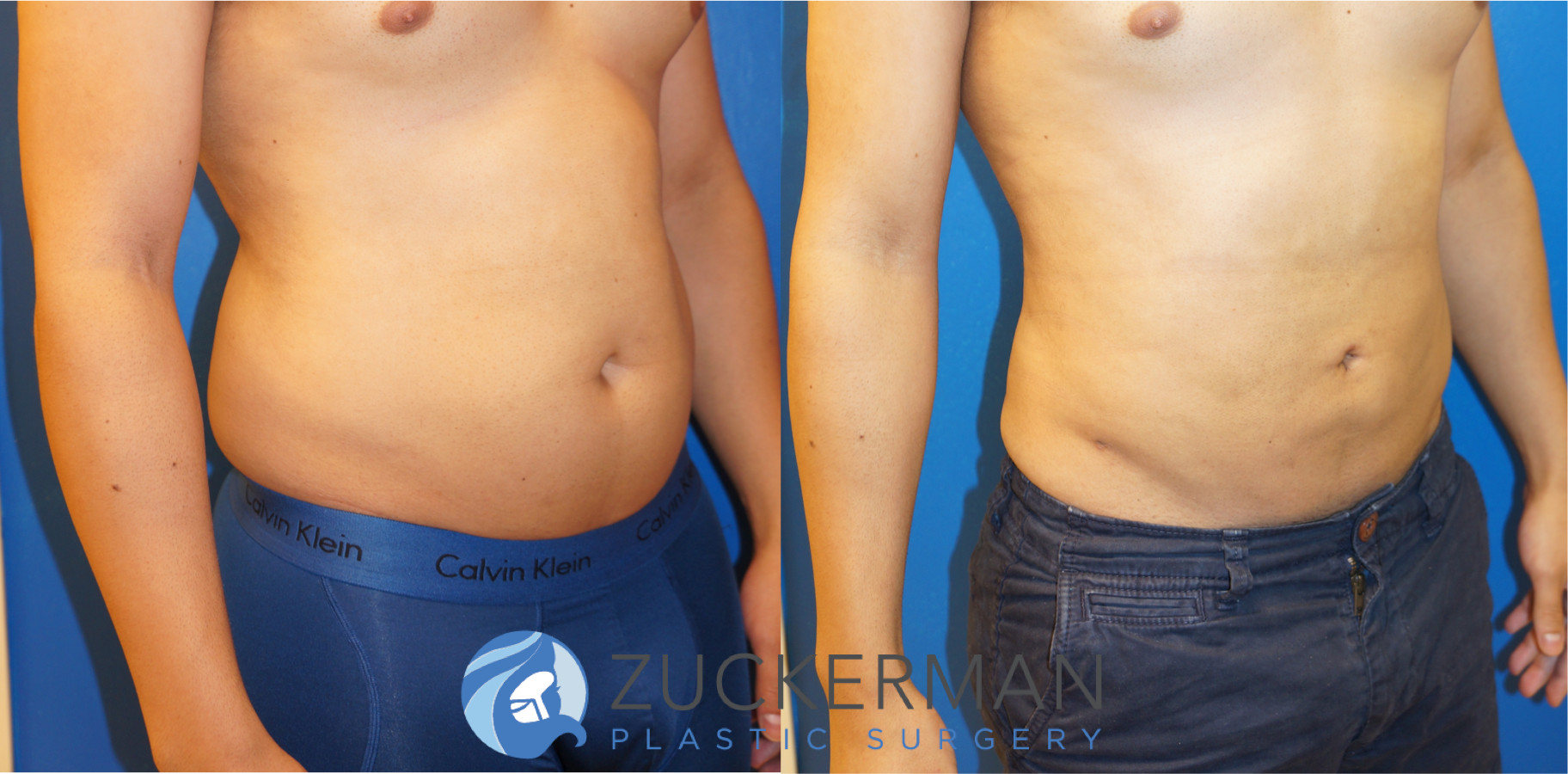liposuction, abdomen, flanks, lower back, right oblique, male, 10, joshua zuckerman md, nyc