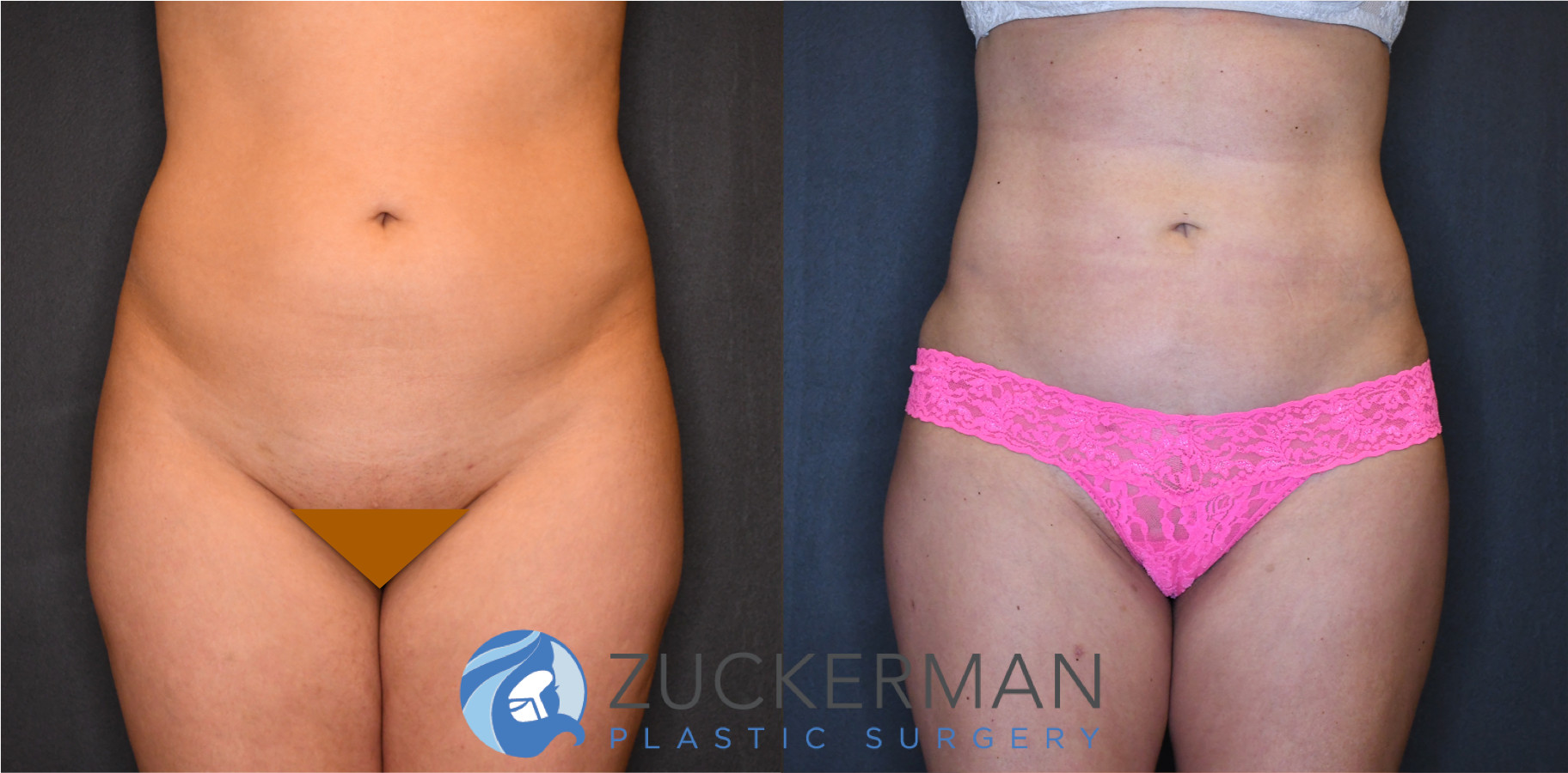 liposuction, abdomen, flanks, lower back, frontal view, 11, joshua zuckerman md, nyc