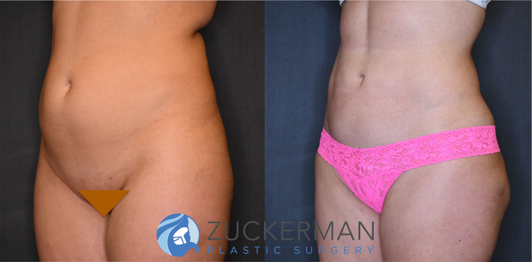 liposuction, abdomen, flanks, lower back, left oblique view, 11, joshua zuckerman md, nyc