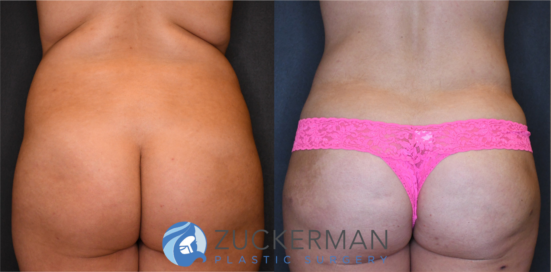 liposuction, abdomen, flanks, lower back, posterior view, 11, joshua zuckerman md, nyc