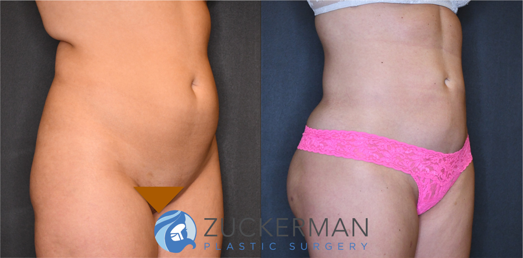 liposuction, abdomen, flanks, lower back, right oblique view, 11, joshua zuckerman md, nyc