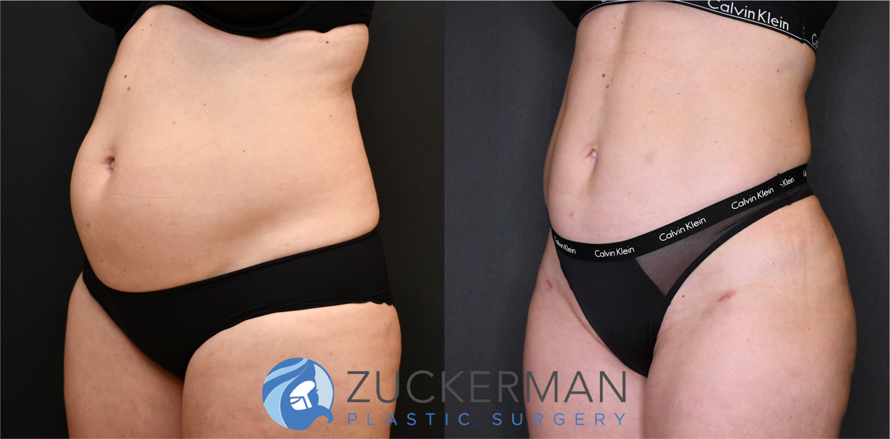 liposuction, abdomen, flanks, lower back, left oblique view, 12, joshua zuckerman md, nyc