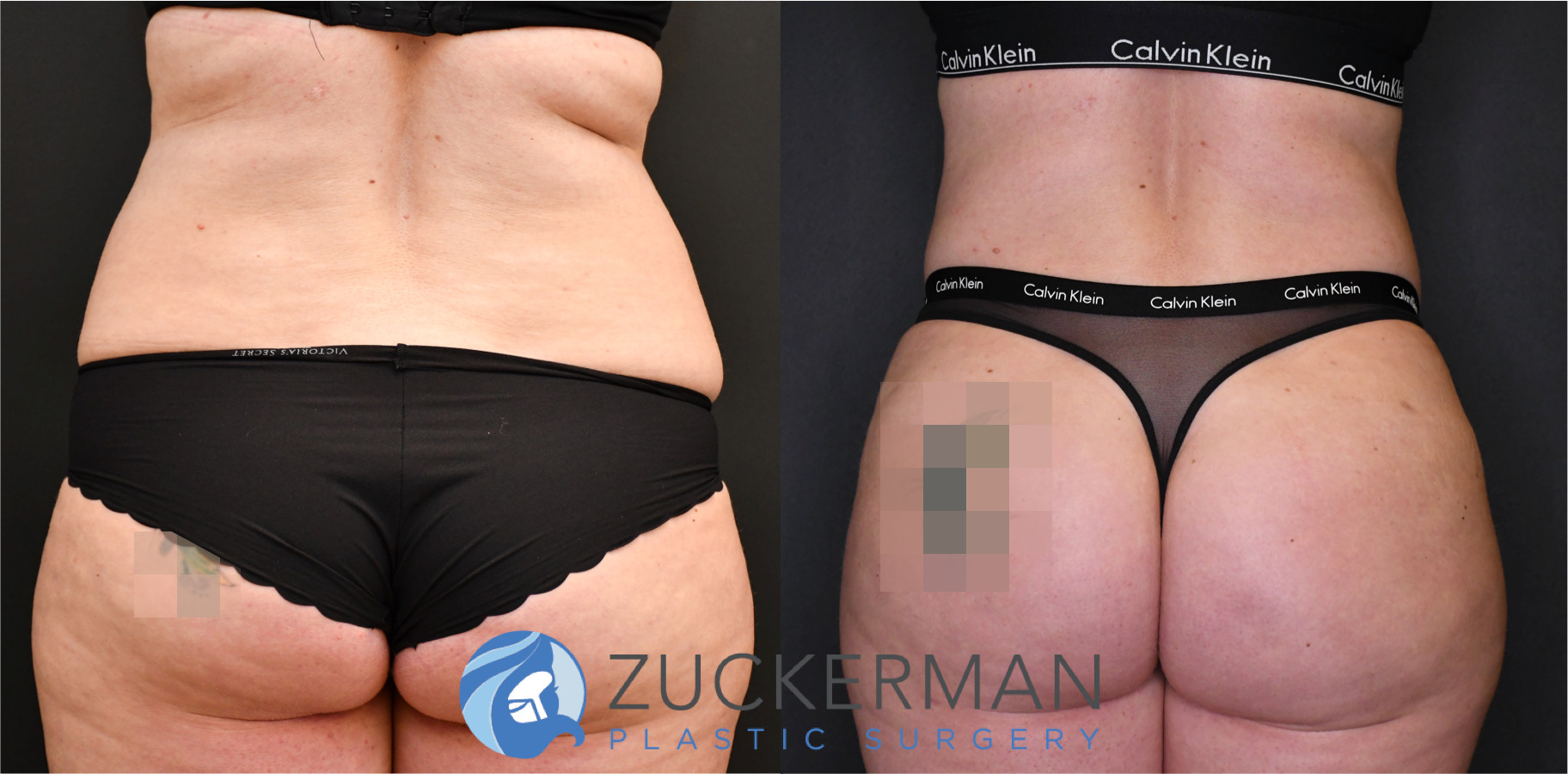 liposuction, abdomen, flanks, lower back, posterior view, 12, joshua zuckerman md, nyc