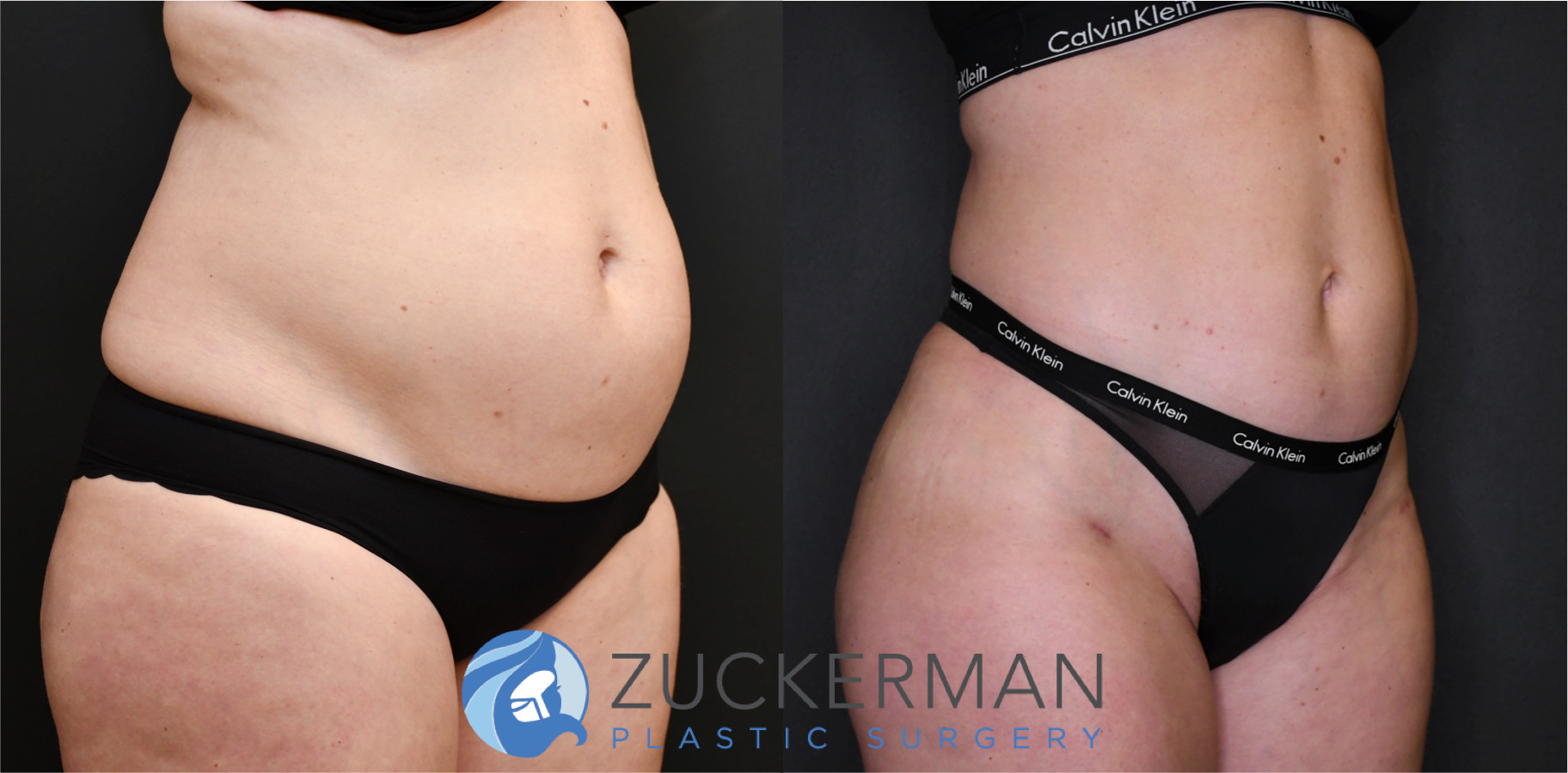 liposuction, abdomen, flanks, lower back, right oblique view, 12, joshua zuckerman md, nyc