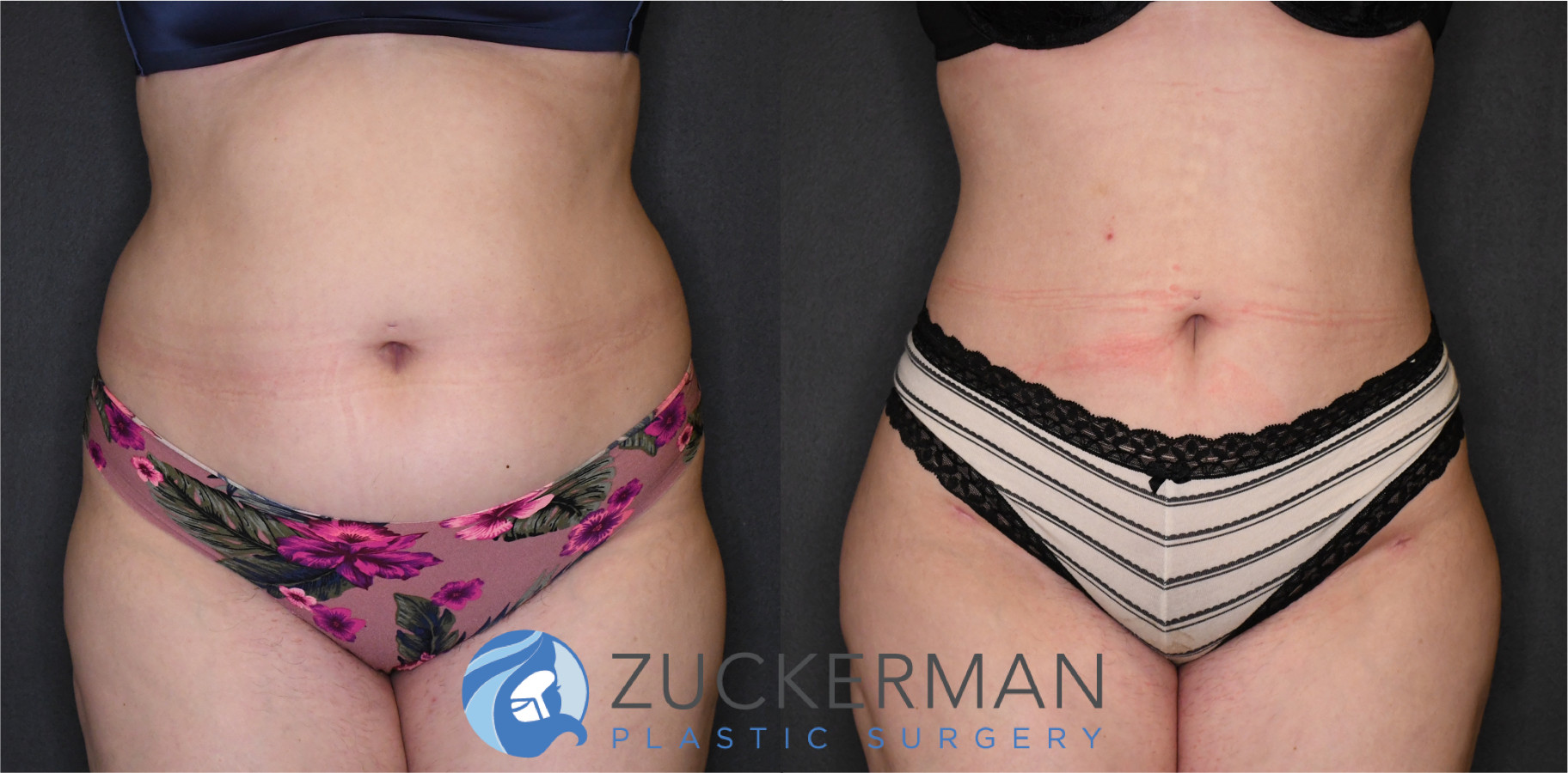 liposuction, abdomen, flanks, lower back, lipo 360, 13, frontal, joshua zuckerman md, nyc