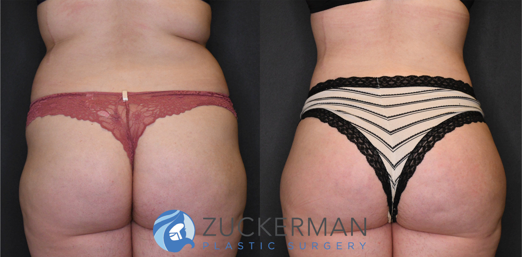 liposuction, abdomen, flanks, lower back, lipo 360, 13, posterior, joshua zuckerman md, nyc