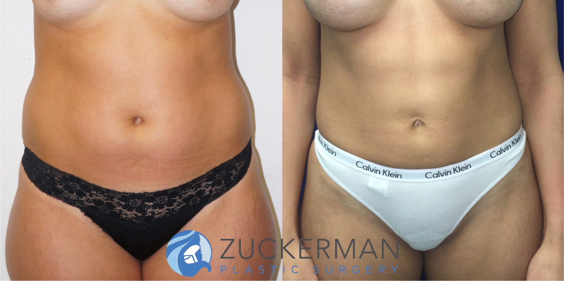 liposuction, abdomen, flanks, 1, joshua zuckerman md, nyc