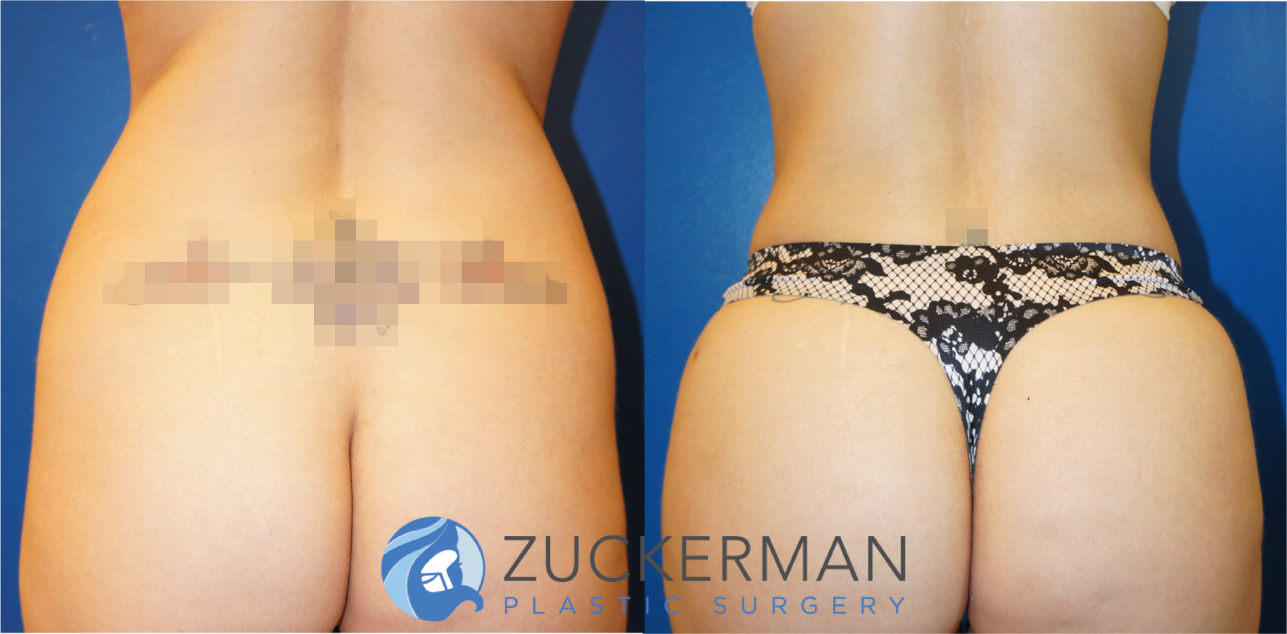 liposuction, abdomen, flanks, lower back, lipo 360, 2, joshua zuckerman md, nyc