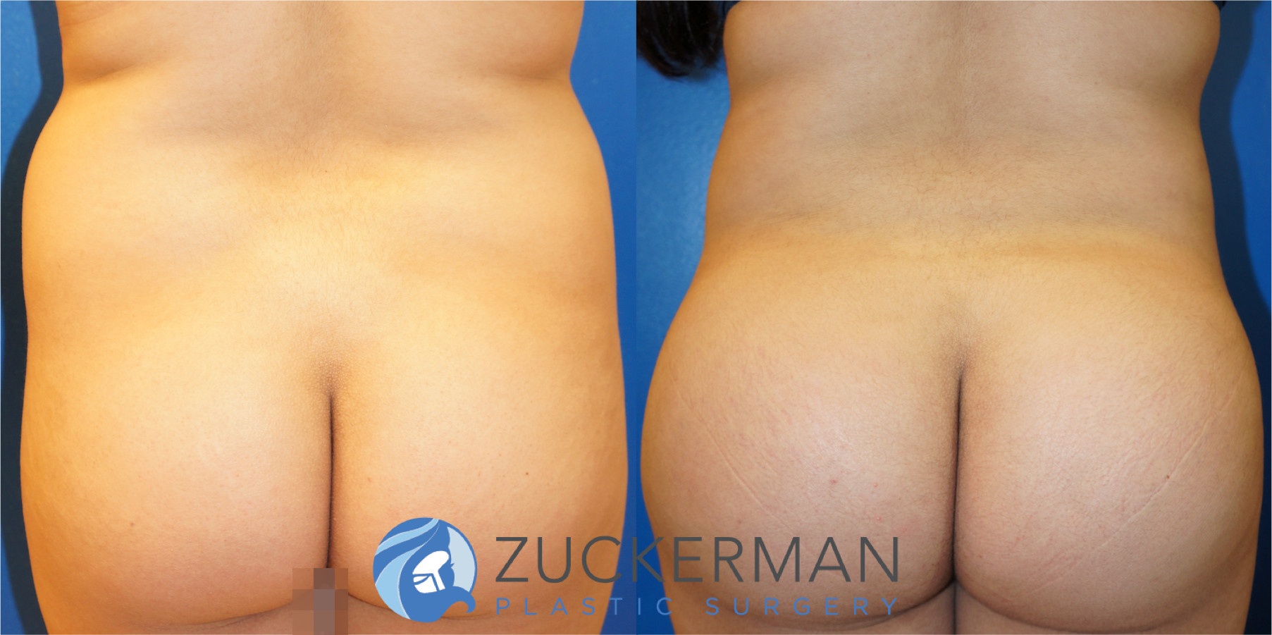 liposuction, abdomen, flanks, lower back, lipo 360, 3, posterior view, joshua zuckerman md, nyc