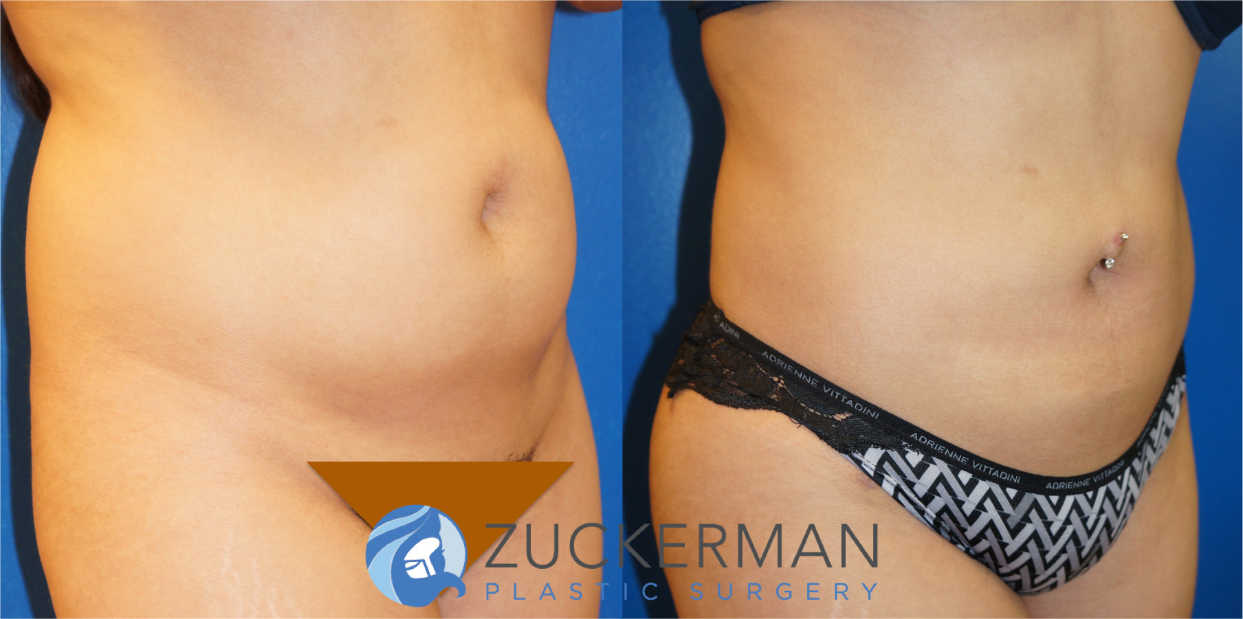 liposuction, abdomen, flanks, lower back, lipo 360, 3, right oblique view, joshua zuckerman md, nyc