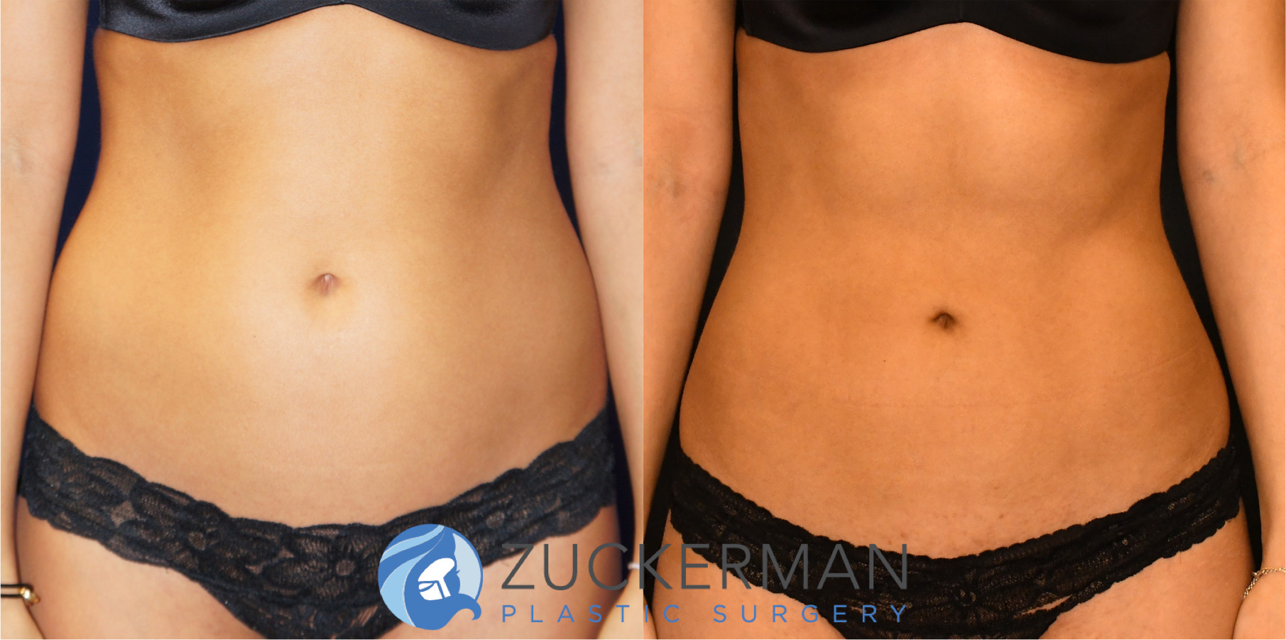 liposuction, abdomen, flanks, frontal view, 7, joshua zuckerman md, nyc