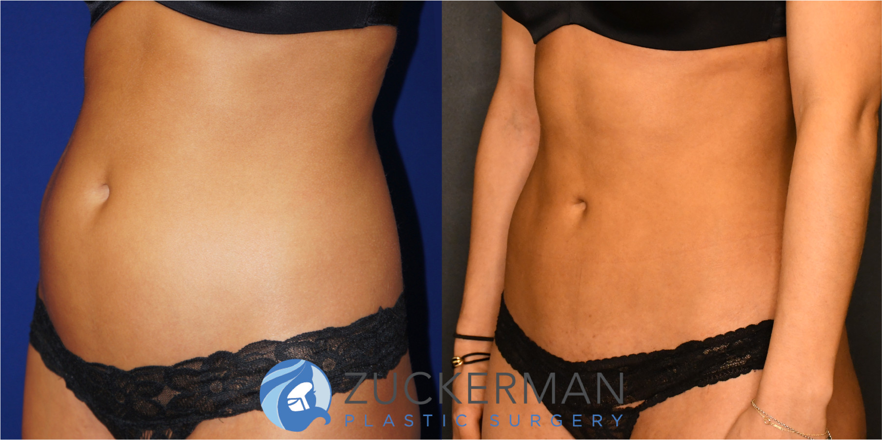 liposuction, abdomen, flanks, left oblique view, 7, joshua zuckerman md, nyc