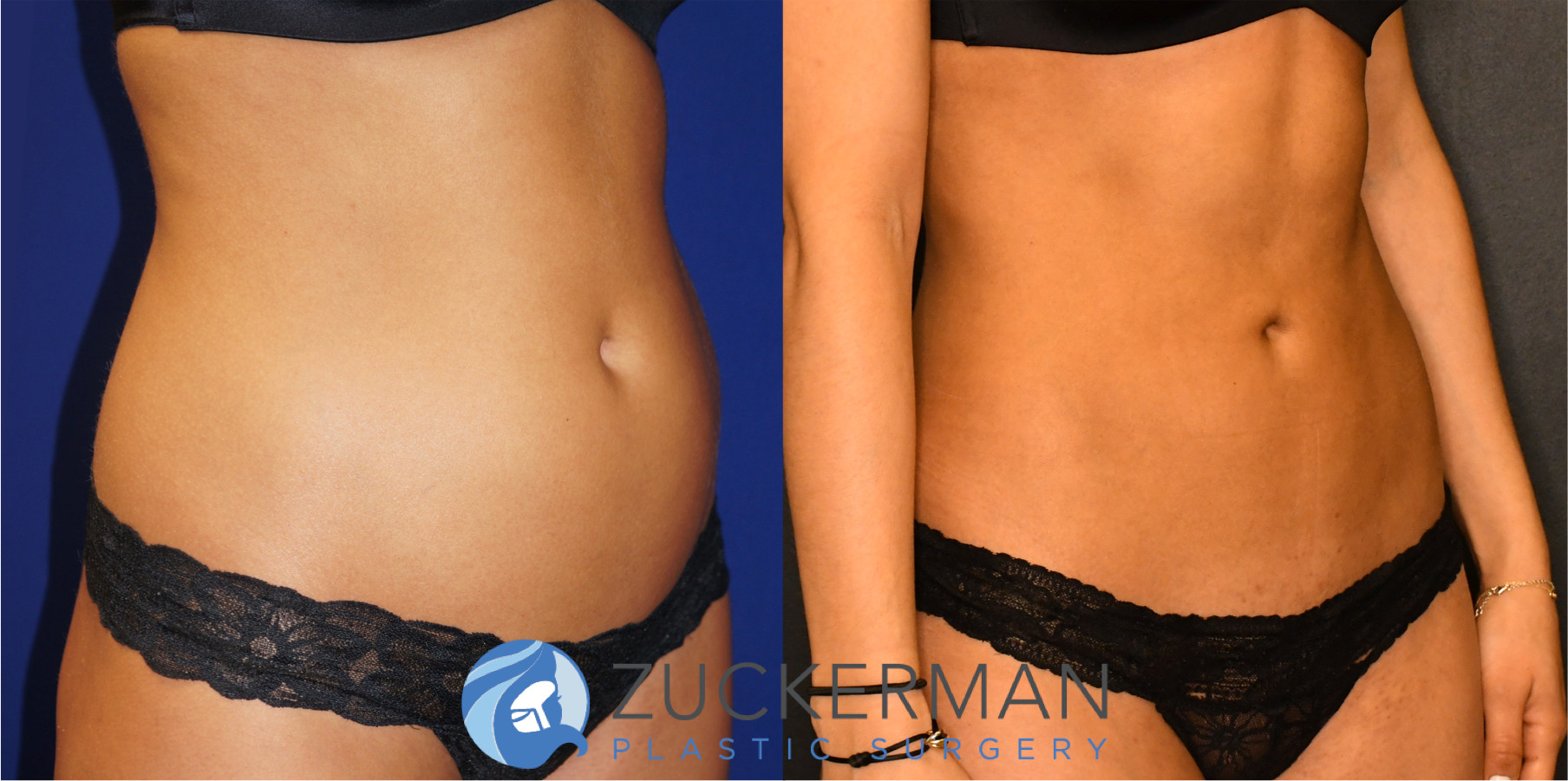 liposuction, abdomen, flanks, right oblique view, 7, joshua zuckerman md, nyc