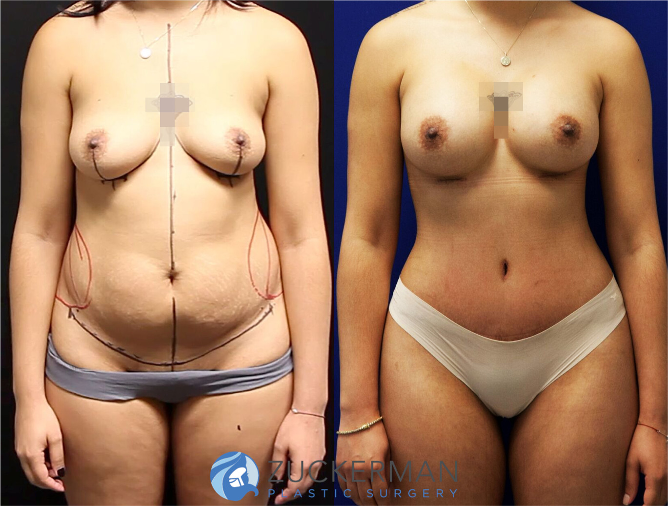mommy makeover, before and after, breast augmentation, tummy tuck, liposuction, 1, joshua zuckerman md, nyc, frontal view