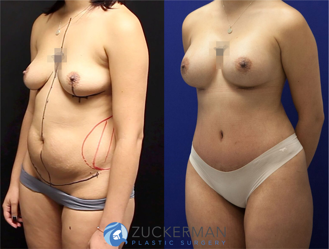 mommy makeover, before and after, breast augmentation, tummy tuck, liposuction, 1, joshua zuckerman md, nyc, left oblique view